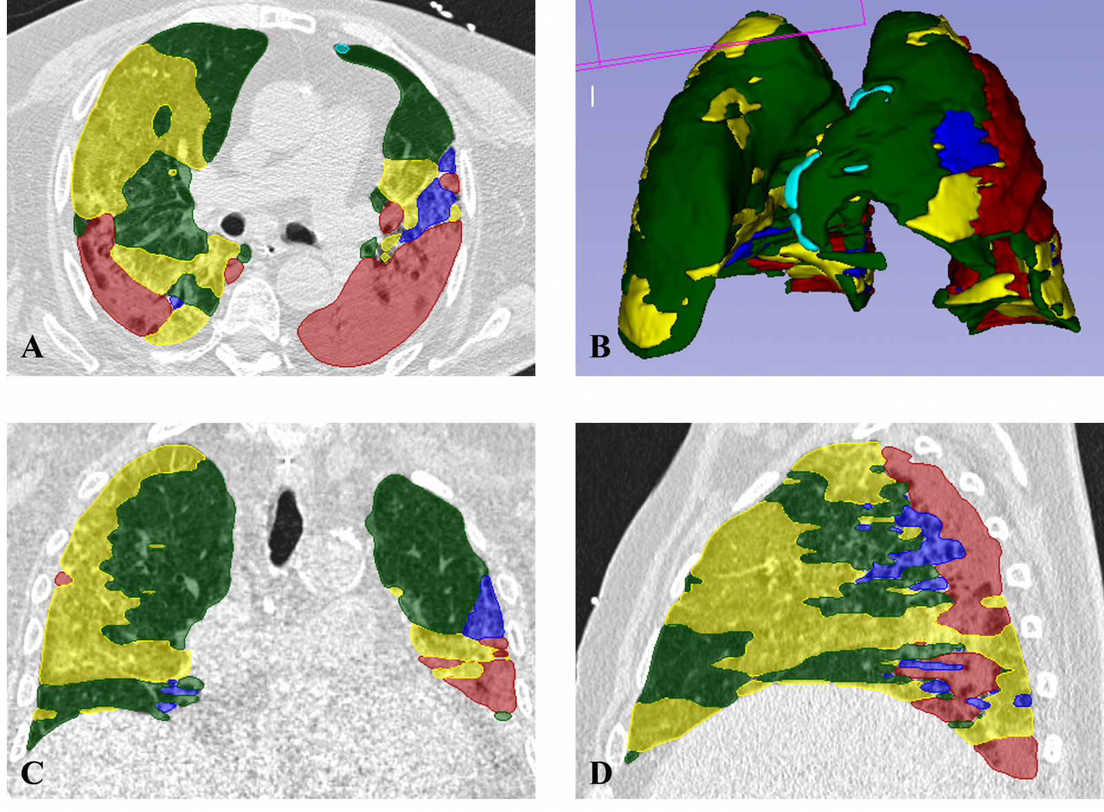  Comprehensive Approaches to COVID-19 Mortality Prediction: Insights from Studies in Reggio Emilia 