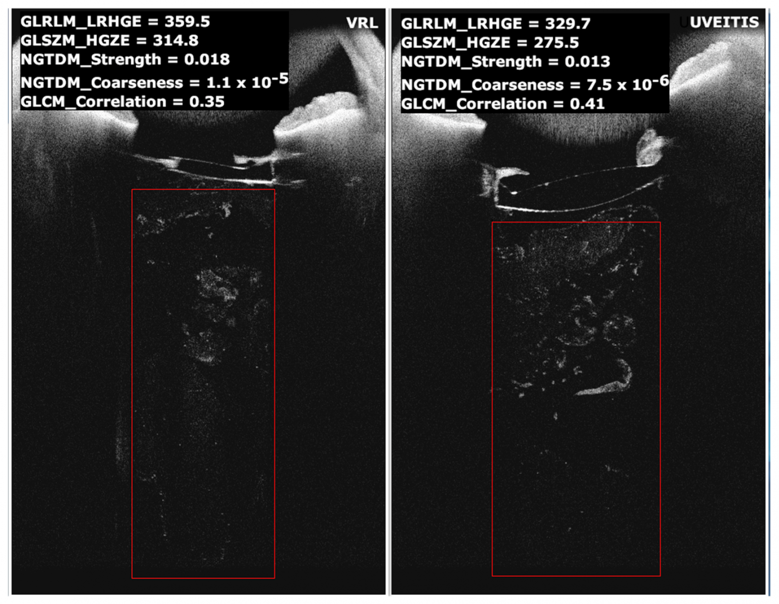 Advancing Ocular Diagnostics: AS-OCT Radiomics in Distinguishing Vitreoretinal Lymphoma from Uveitis
