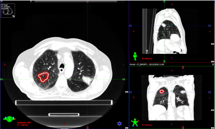 Novel Harmonization Method for Multi-Centric Radiomic Studies in Non-Small Cell Lung Cancer