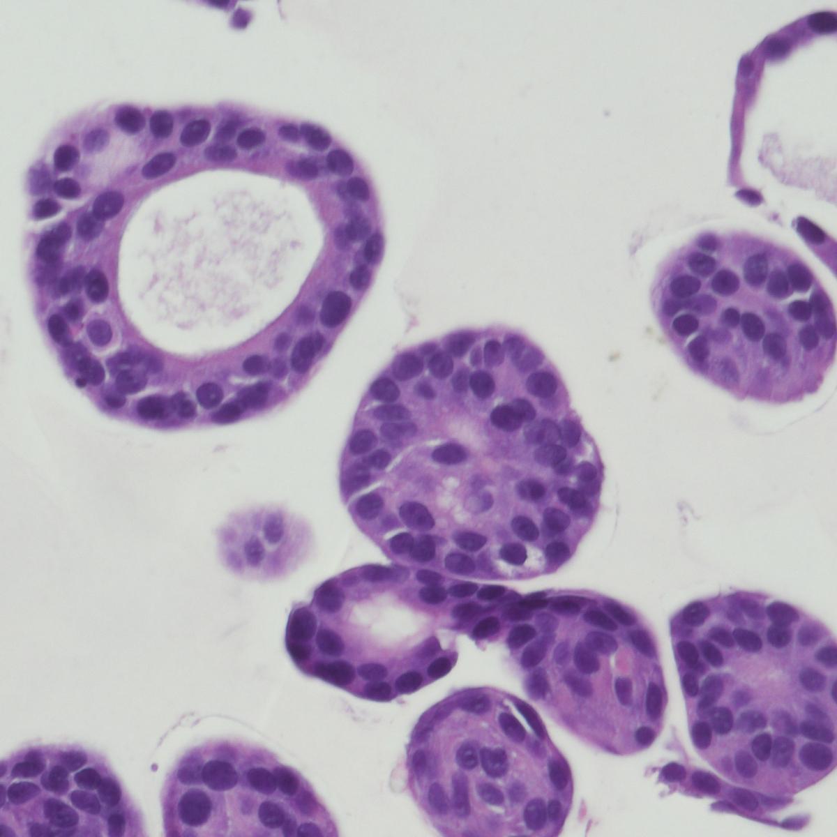 Lung cancer